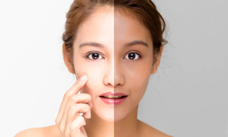 Common Ways on How to Lighten Your Skin Naturally